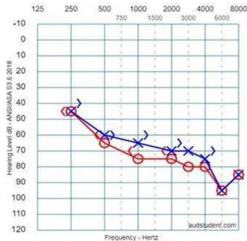 Figure 1C. Index Patient Tonal Audiometry