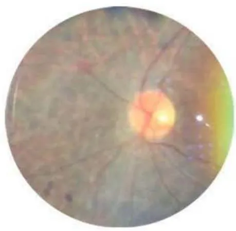Figure 1B. Index Patient right eye funduscopy