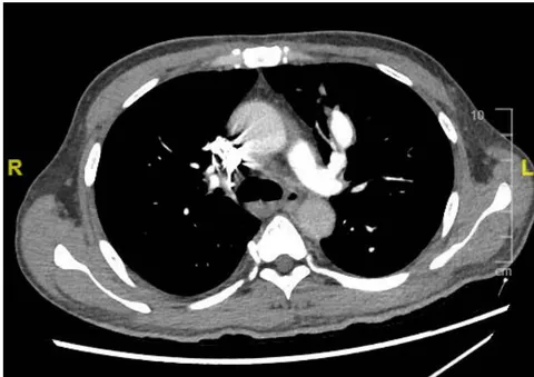Figure 1: Pulmonary artery aneurysm in the segmental branch of left upper pulmonary artery at diagnosis. (White arrow)
