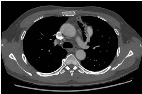 Figure 2: Pulmonary artery aneurysm in the segmental branch of left upper pulmonary artery after 6 months of cyclophosphamide and prednisolone. (White arrow)
