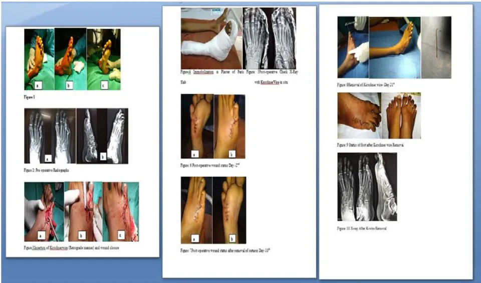 Figure 1: Introduction of Kinchroenter (Retrograde manner) and wound closure