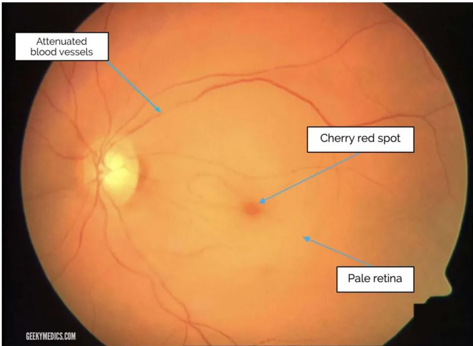 Fig. 2: CRAO with cherry red spot, attenuated blood vessels, pale retina and disc Fig. 3: CRAO