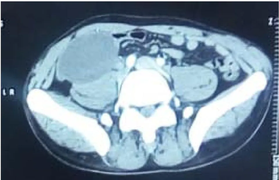 Figure 7: Scannographic section showing the cystic mass coming into contact with the psoas in the right iliac fossa.
