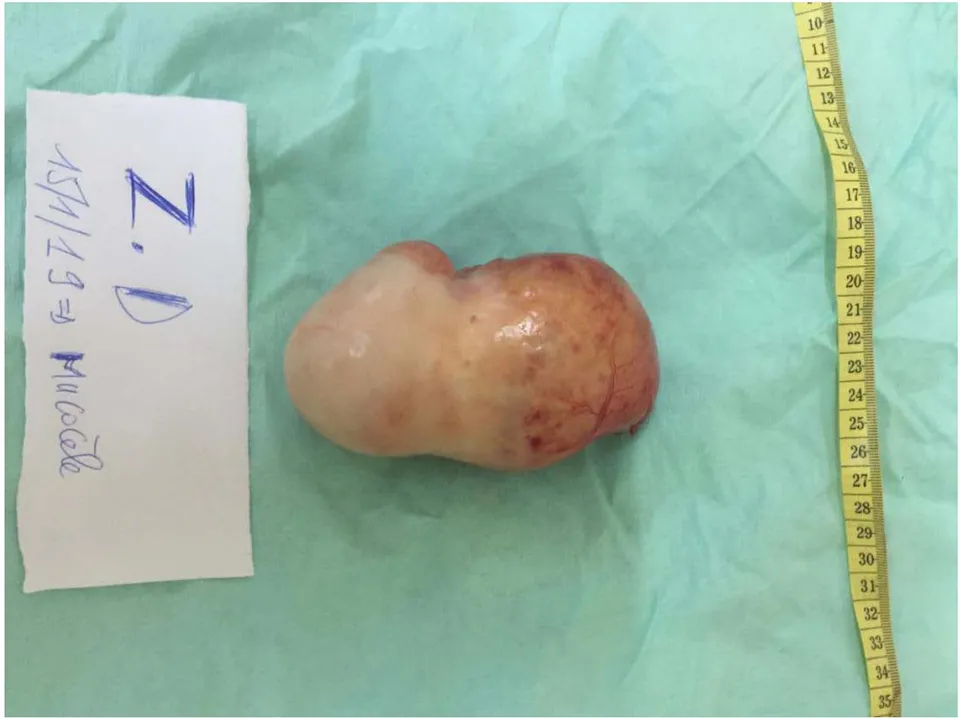 Figure 9: Appearance of an appendiceal mucocele after appendectomy. Note the pearly white oblong appendicular mass.