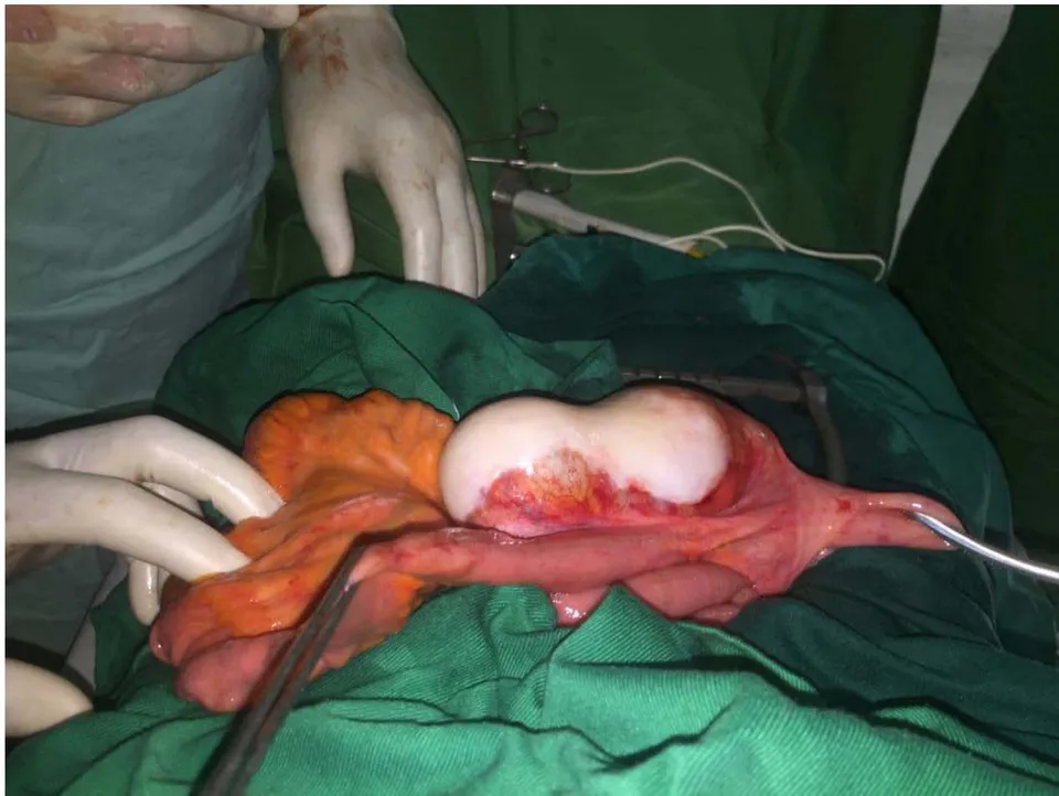 Figure 8: Intraoperative findings: elongated pearly white mass located at the ileocaecal junction (ileum: left clamp and cecum: right clamp).