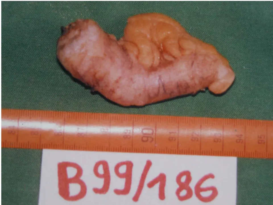 Figure 4: Appendectomy specimen for appendiceal mucocele: Note the swollen appearance of the appendix especially marked in its proximal half.