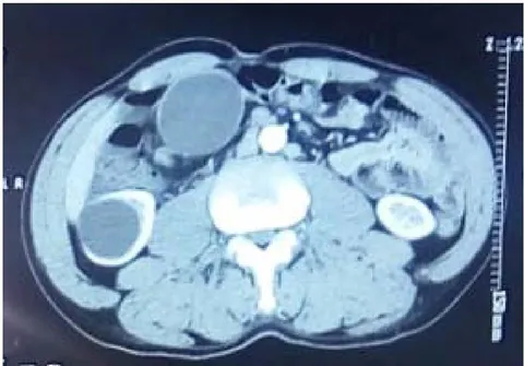 Figure 6: CT scan section showing the cystic mass with wall enhancement (thin arrow). Note the cyst on the lower pole of the right kidney (thick arrow).
