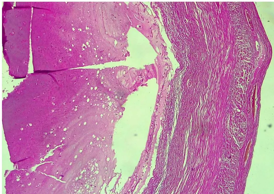 Figure 1: Appearance of an appendicular mucocele after formalin fixation. Note the increased volume of the distal half of the appendix. Figure 2: HE x 250: histological aspect of an appendicular mucocele showing a dilated lumen with abundant mucoid substance infiltrating the smooth muscle layers and serosa.