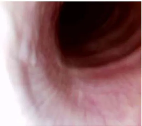 Fig. 4: Videoendoscopy Image Showing Increased Space between the Tracheal Rings of a Horse with Cervical Problems, Non-Congenital Problems (Bule Arrow)