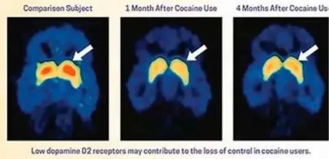 Figure 6: D2Rs (DA2 Receptors) in cocaine users. Harvard Medical School (2021). Understanding Addiction As a result, over time, more of the substance is required to achieve the same electrical energy as occurred with the first experience. Additional adaptations which the neuron can perform are duplicating itself (in developing brains, mitosis) and change dendritic configuration. Advanced substance