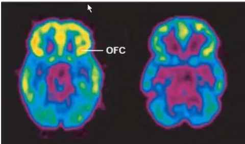 Figure 8: Harvard Medical School (2021). Understanding Addiction. OFC refers to orbitofrontal cortex