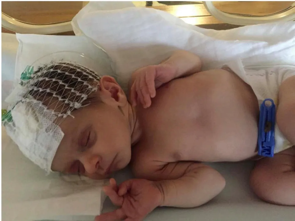 Figure 1: Newborn with hypernatremic dehydration. Physical examination shows an emaciated appearance, jaundice, sunken eyes and skin turgor.