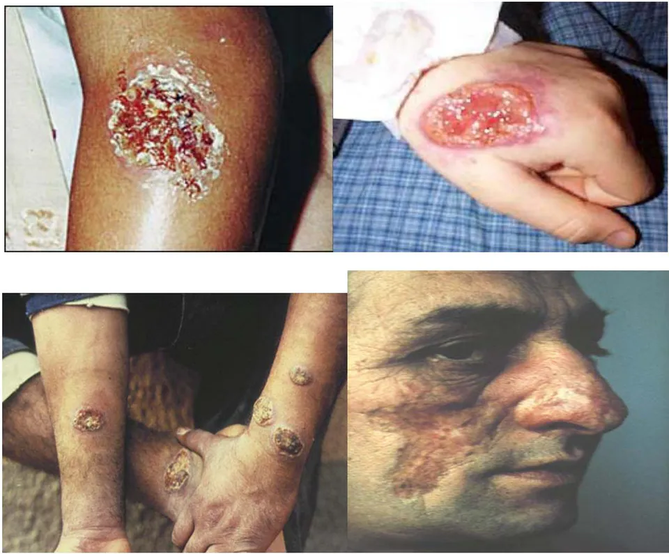 Figure 3: Symptoms of Zoonotic Cutaneous Leishmaniasis (ZCL)