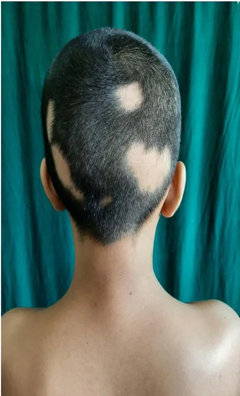 Figure 6: Multiple well demarcated, smooth, bald, round alopecic patches of hair loss of varying sizes on the scalp.