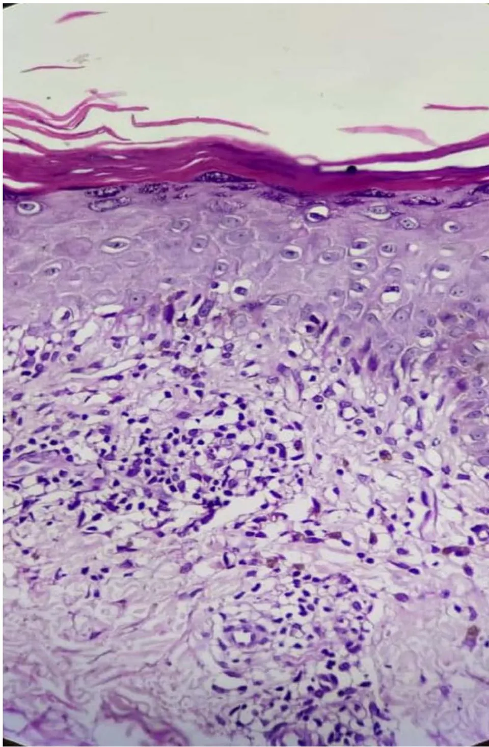 Figure 4: Photomicrograph showing hyperkeratosis, parakeratosis, hypergranulosis, band of dense lymphocytic inflammatory infiltrate, histiocytes admixed with congested blood vessels, along with periadnexal inflammatory infiltrate. (H & E, x 40).