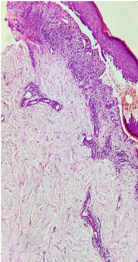 Figure 5: Photomicrograph showing hyperkeratosis, parakeratosis, hypergranulosis, artifactual cleft formation between epidermis and papillary dermis (Max Joseph space), band of dense lymphocytic inflammatory infiltrate, histiocytes admixed with congested blood vessels, along with periadnexal inflammatory infiltrate. (H & E, x 10).