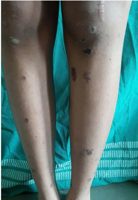 Figure 1: Multiple violaceous papules to plaques of varying sizes over the extensor aspects of both legs bilaterally.