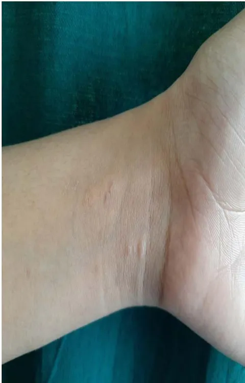 Figure 3: Few erythematous papules over the wrist area.