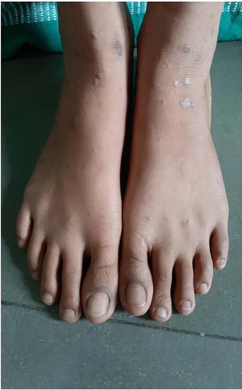 Figure 2: Multiple violaceous papules to plaques over the dorsum of feet bilaterally.
