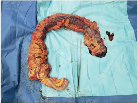 Figure 7: Post-surgery aspect of the colon