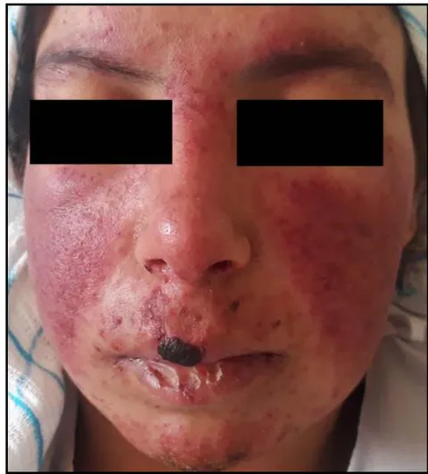 Figure 1: Facial malar rash