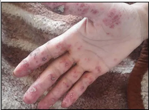 Figure 2: Finger discoid lesions