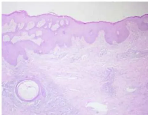 Fig. 4: Reactive lymphadenopathy with a pattern of follicular and paracortical hyperplasia, with no evidence of neoplasia