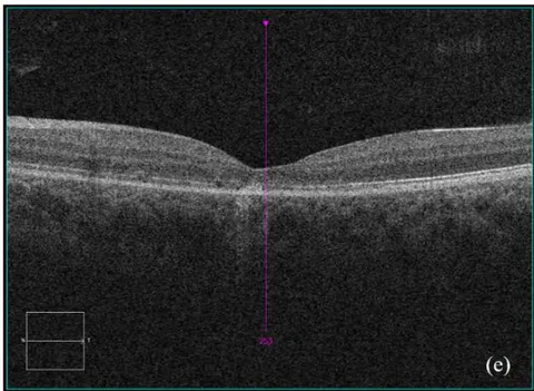 Figure 4: Clinical status 4-months following treatment. (a) Right eye fundus photo, (b) left eye fundus photo, OCT macular cube (c) and OCT RNFL analysis demonstrating improvement of optic nerve head swelling, peripapillary and subfoveal subretinal fluid. (e) Enlarged OCT macular cube demonstrating outer retinal layer loss at the fovea contributing to persistent low vision.