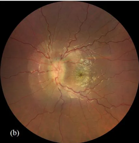 Figure 1: Fundus photography of right eye (a) and left eye (b). The left eye demonstrates diffuse optic nerve head swelling with macular hard-exudates in a star pattern characteristic of left neuroretinitis.