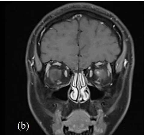 Figure 3: MRI head and orbits with (a); T2 axial TSE FLAIR sequence and (b); T1 coronal TSE Dixon sequence with contrast. Focal enhancement of the anterior margin of the left optic nerve at its junction with the globe is demonstrated without other demyelination or parenchymal intracranial pathology.