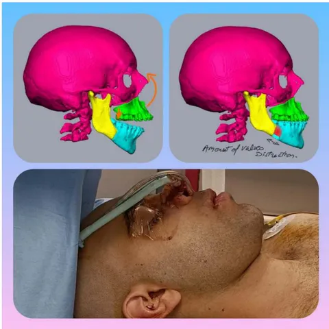 Fig. 9: Counter rotation of the maxilla by inducing secondary counter rotation of the mandible gives better volume to the chin avoiding genioplasty Surgery which is somehow destructive to the Genioglossus thus counter-productive as far as the cure to Apnea. Dr. Eric Solyom
