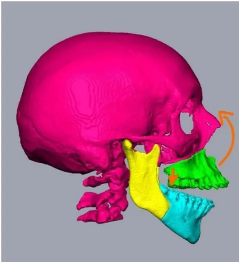 Fig. 8: Counter clockwise rotation of the maxilla induces secondary counter clockwise rotation of the mandible