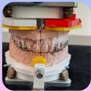Fig. 2: Orthognator (the Multi colored appliance) and Maxillary dual-screw-expander: An interface to drastically improve the Galletti Articulator