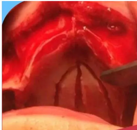 Fig. 11: A: Cast Chrome Cobalt Dual-screw-rapid expander© permits very precise opening gradients of the palatal vault without damage to the medial papilla. B: Prospective or final surgical guide equilibrated by half arches are subsequently recomposed on a plaster key A