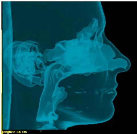 Fig. 1: KC cephalometric X-rays and analysis before and after Surgery showing Narrowness of the retro-basi-lingual area before surgery