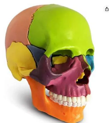 Fig. 3: The assembly of the puzzle, and on the right maxilla an additional osteosynthesis plate as an anchoring supplement. Surgery Jean-François Tulasne showing not only bone syntheses by plates but also intermaxillary grafting by bone transplants