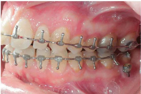 Fig. 4: Predictive assembly, simulation of a Cl3 case and then manufacture of a surgical guide consistent with maxillary expansion and sagittal over-correction, then balanced so that its per-operative insertion is indisputable
