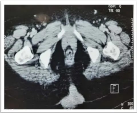 Figure 1: Preoperative image of a giant right gluteal mass