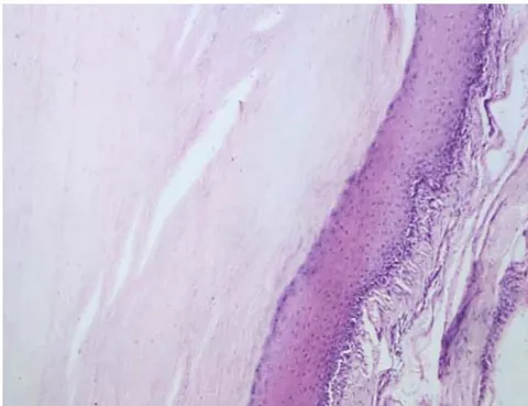 Figure 3: Image showing the surgical specimen of the right gluteal region Figure 4: Pathological specimen demonstrated a mammaries cystic formation with a stratified, keratinized epithelium in the wal. (coloration HE Gx100)