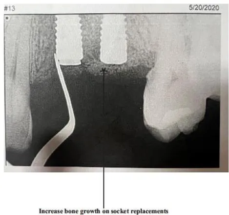 Figure 4: An X-ray photo of socket insertion for tooth replacement on December 13, 2019.