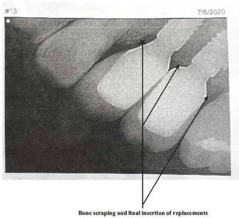 Figure 5: An X-ray photo six months after socket insertion of bone overgrowth on socket replacements on May 20, 2020 Figure 6: An X-ray shows the successful completion of the teeth replacements after bone scraping and final insertion of replacements on July 06, 2020.