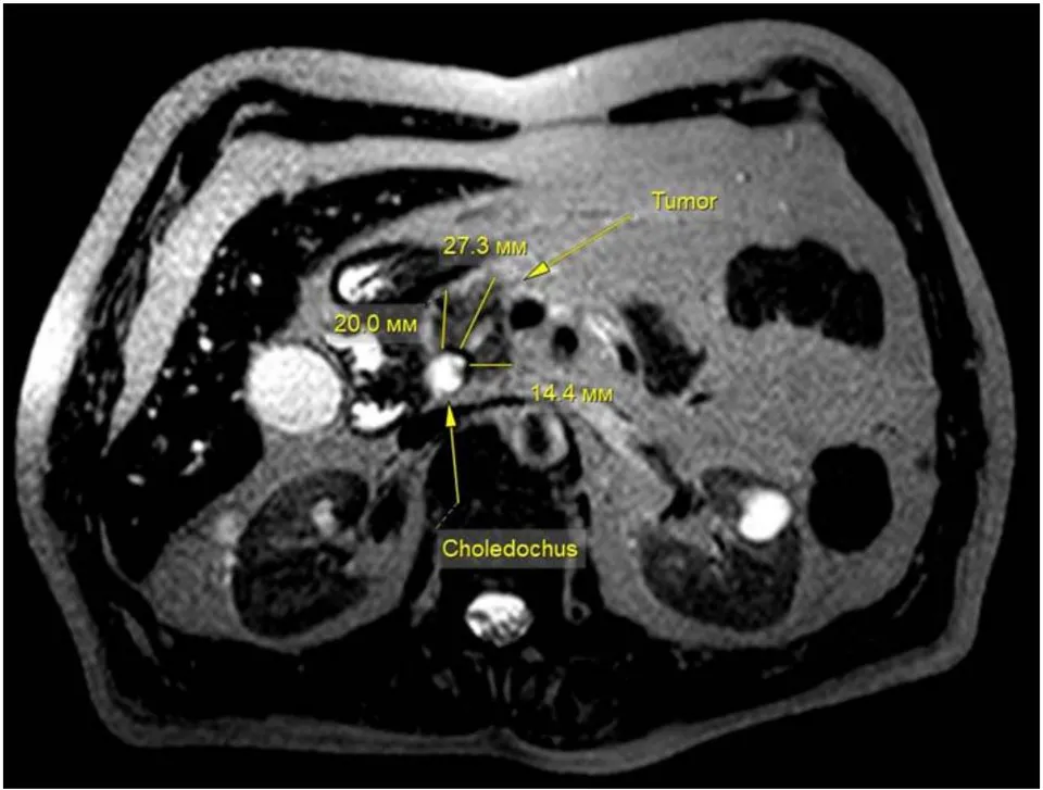 Fig. 10: Ante - medial localization of the tumour