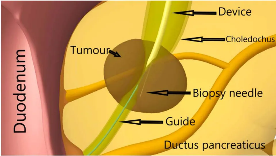 Fig. 11: Transcholangiostomy trephine biopsy of a tumour of the head of the pancreas by E.B.Revazov - Ts.S.Khutiev