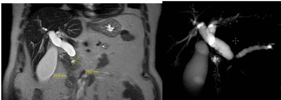 Fig. 12: Preoperative analysis of MRI of the abdominal cavity with MR-cholangiography