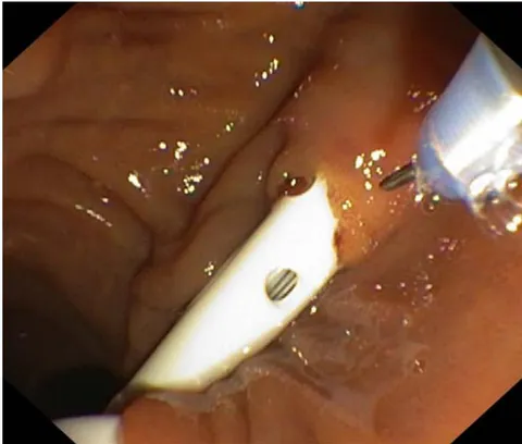 Fig.15: Endoscopic papillosphincterotomy.