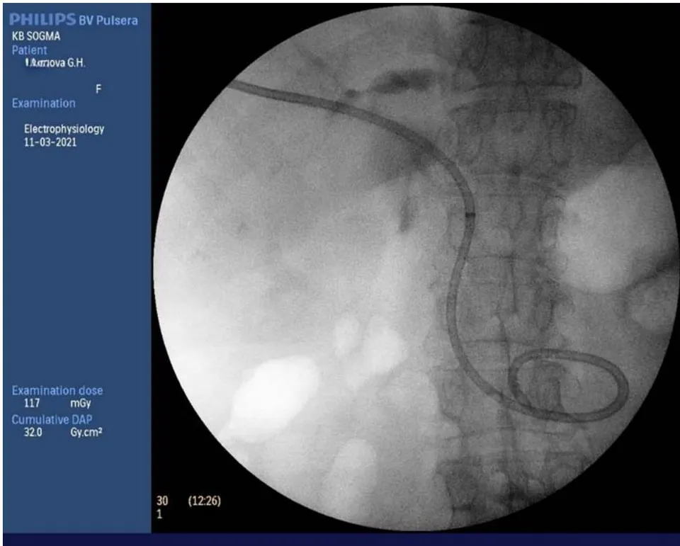 Fig. 14: External-internal drainage of the bile duct