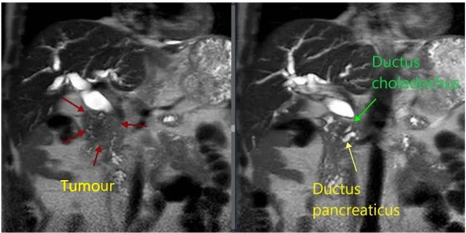 Fig. 8: Preferential localization of the tumour in relation to hepaticocholedochus