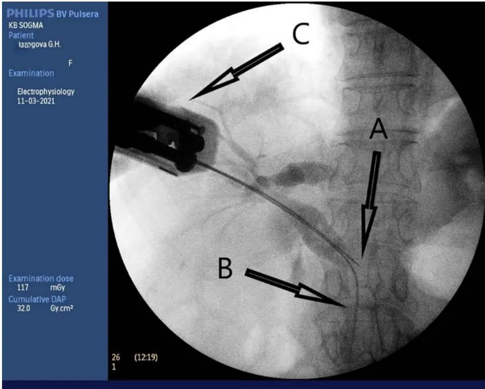 Fig. 13: Transcholangiostomy trephine biopsy of a tumour of the head of the pancreas (A - Biopsy needle; B - Super-rigid guide; C - biopsy gun.)