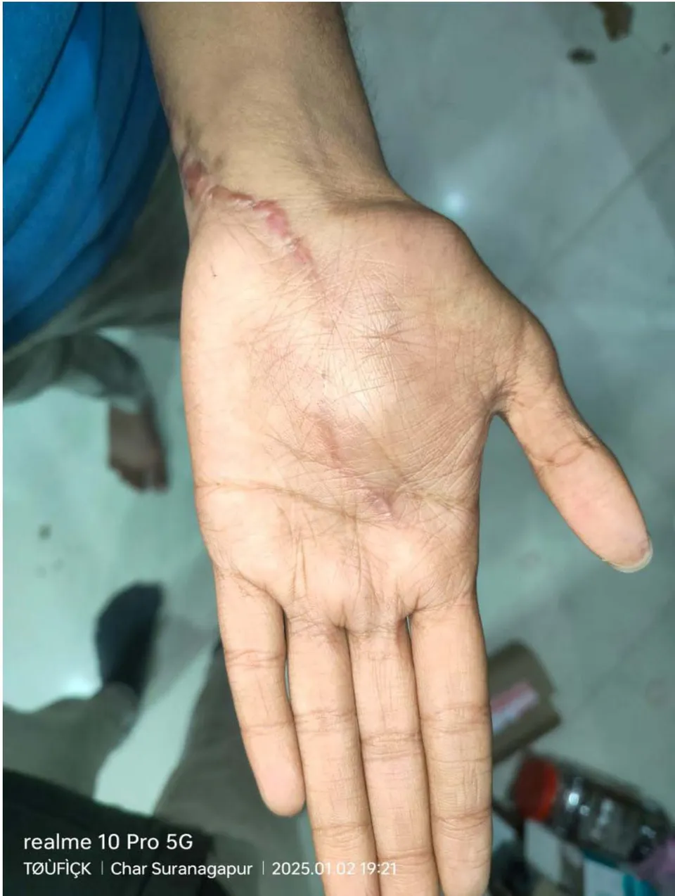 Figure 9: Late Post operative image of palm of patient's Left hand