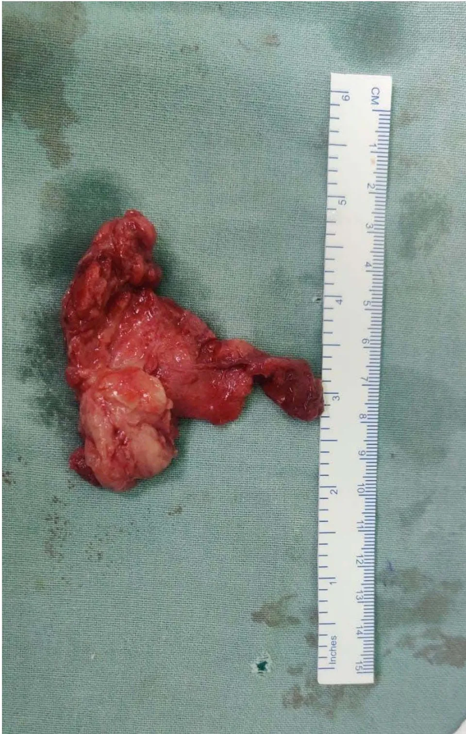 Figure 3: Fibrolipoma of the Left hand Median nerve